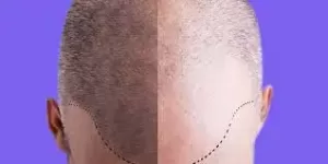 Scalp-micropigmentation