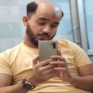 Anassheikh-Parmanent-hair-patch-Solution in wakad