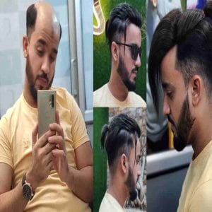 Anassheikh-Parmanent-hair-patch-Solution in wakad