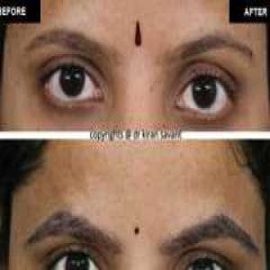 Best Hair Transplant Treatment in Wakad