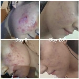 Acne Treatment - Renaissance Derma Clinic, Wakad