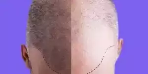 Scalp-micropigmentation